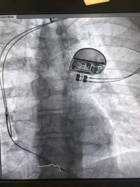 В Мытищинской ГКБ проведена операция по установке больному постоянного кардиостимулятора